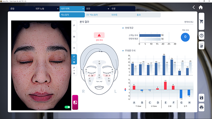 JANUS Pro 색소 침착 분석 화면