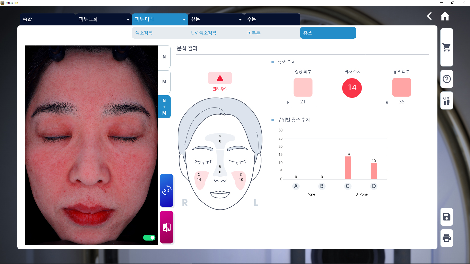 JANUS Pro 홍조 분석 화면